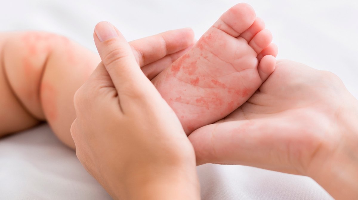 İstanbul’da kızamık alarmı!