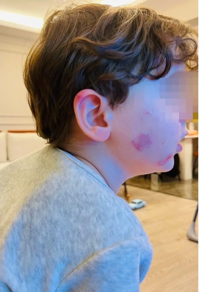 Kreşe bıraktığı çocuğunu darp edilmiş halde aldı